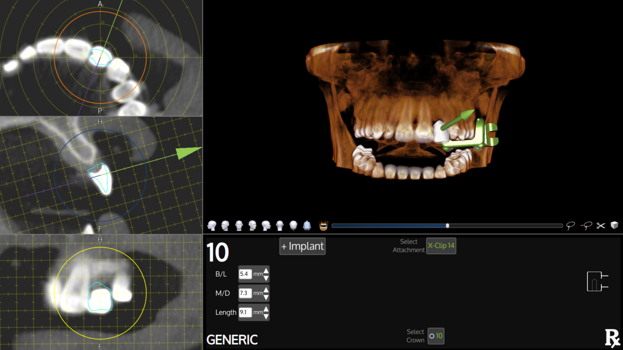 Implants » XNav Technologies