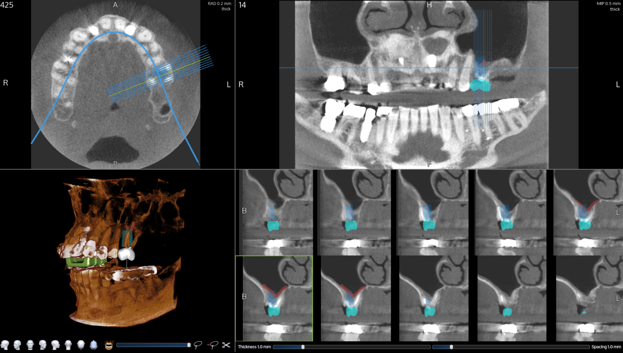 Sinus Elevation in Real Time » X-Nav Technologies