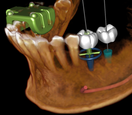 Patients, 3D implant, X-Clip