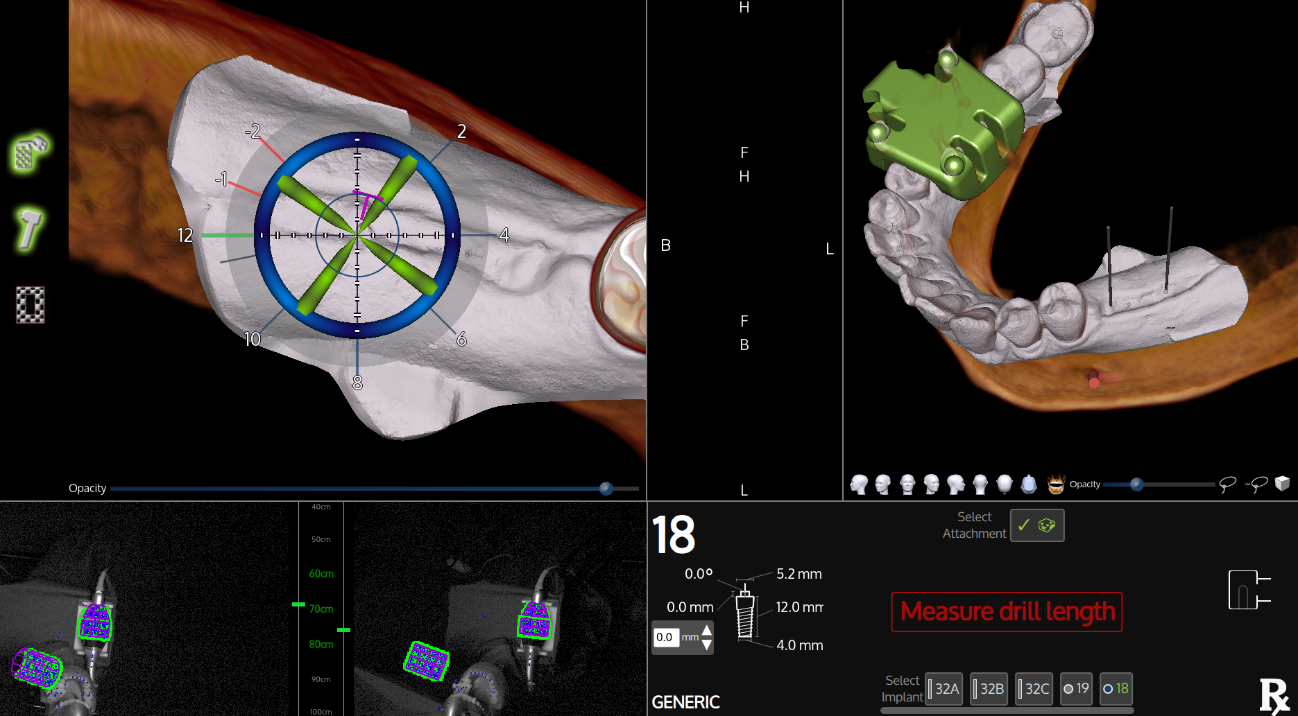 How X-Guide Dynamic Navigation Works in Dental Implant Surgery